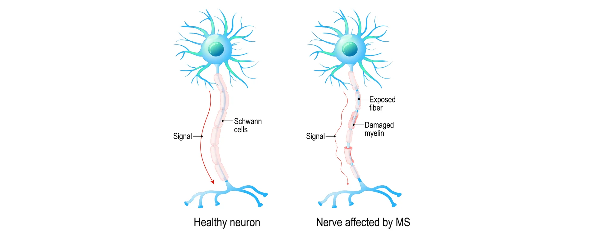 MS or Multiple Sclerosis